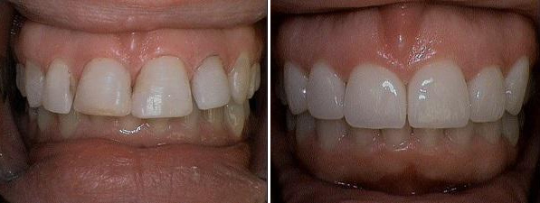 Before and after photo of dental crowns by Dr. Barrera
