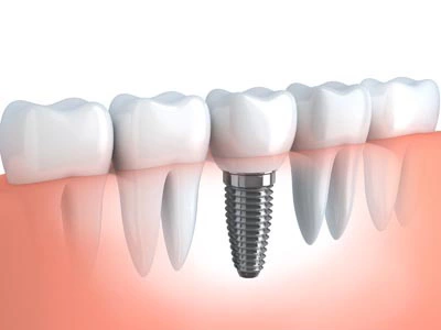 diagram of a single dental implant