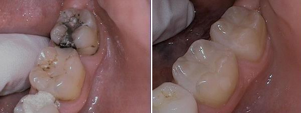 dental fillings performed by Dr. Barrera