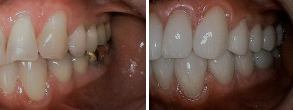 dental implants performed by Dr. Barrera