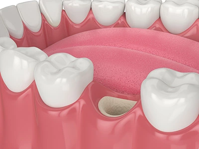 diagram showing a bone graft