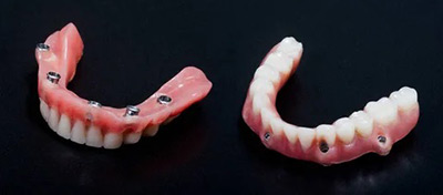 hybrid implant dentures