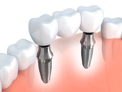 diagram of a dental bridge