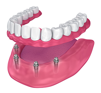 implant-retained overdentures