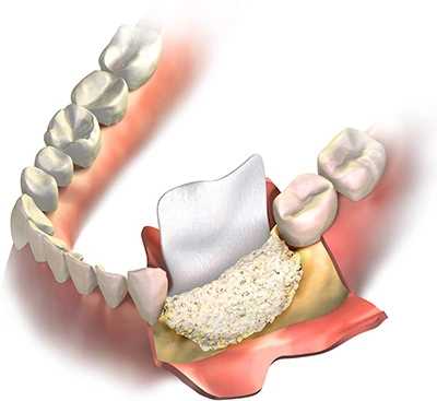 diagram of a ridge augmentation procedure