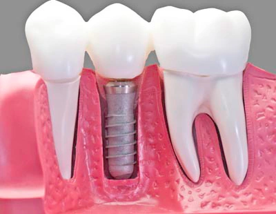 diagram of a dental implant