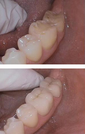 before and after photo of a dental crown